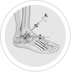 Ankle Arthroscopy